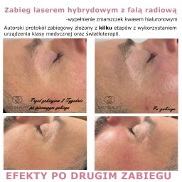 Bezinwazyjny zabieg z efektem wypłycającym zmarszczki oraz nawadniającym.