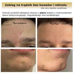 Terapie ukierunkowane na trądzik z wykorzystaniem technik bezinwazyjnych.