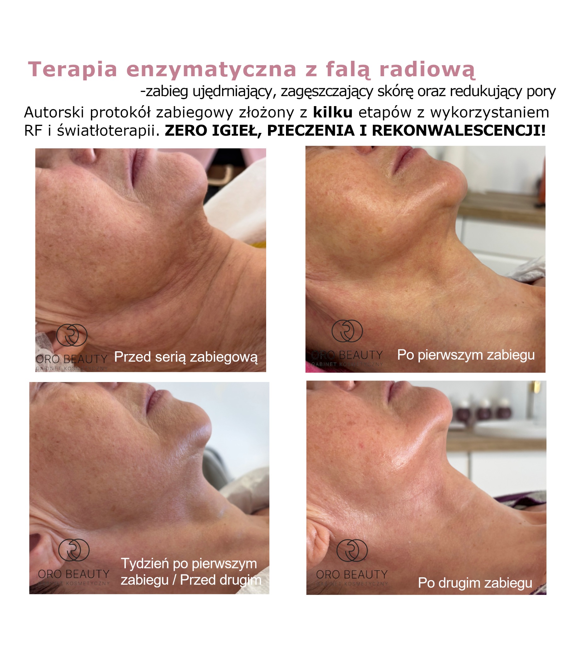 Kompozycja czterech zbliżeń na szyję klientki przed i po serii enzymatycznych zabiegów z falą radiową, prezentująca poprawę jędrności i redukcję zmarszczek. Widoczne logo salonu kosmetycznego.