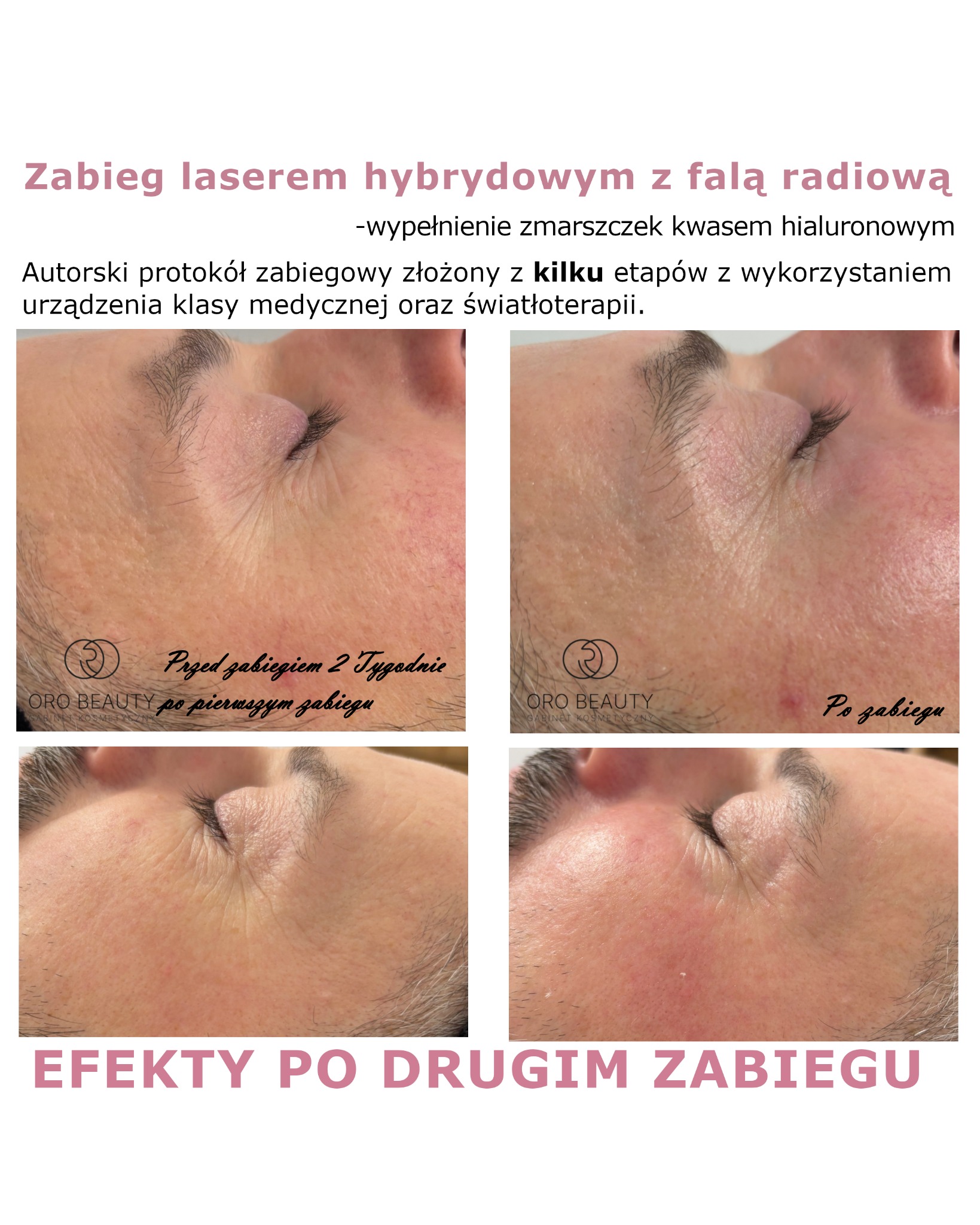 Bezinwazyjny zabieg z efektem wypłycającym zmarszczki oraz nawadniającym.