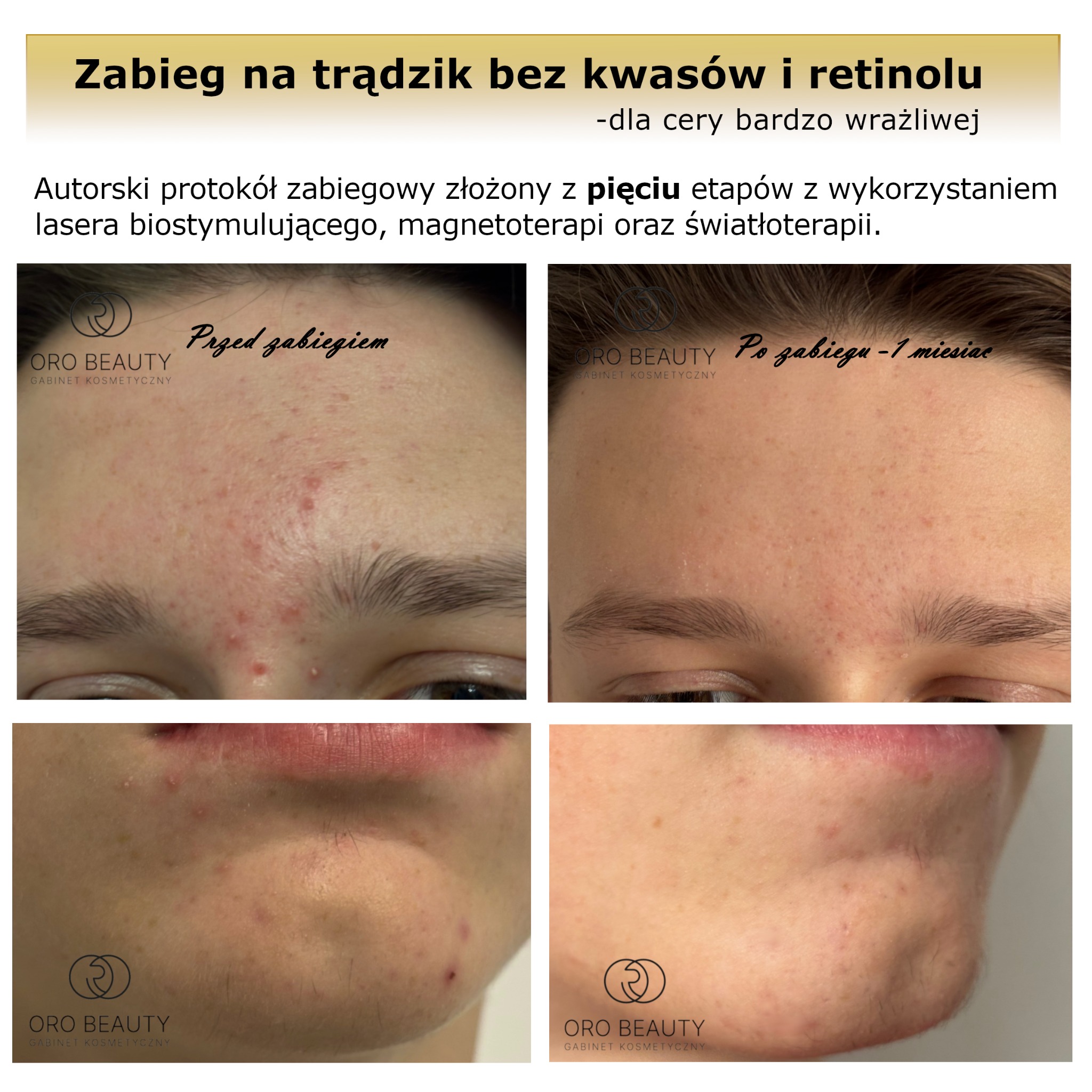 Terapie ukierunkowane na trądzik z wykorzystaniem technik bezinwazyjnych.