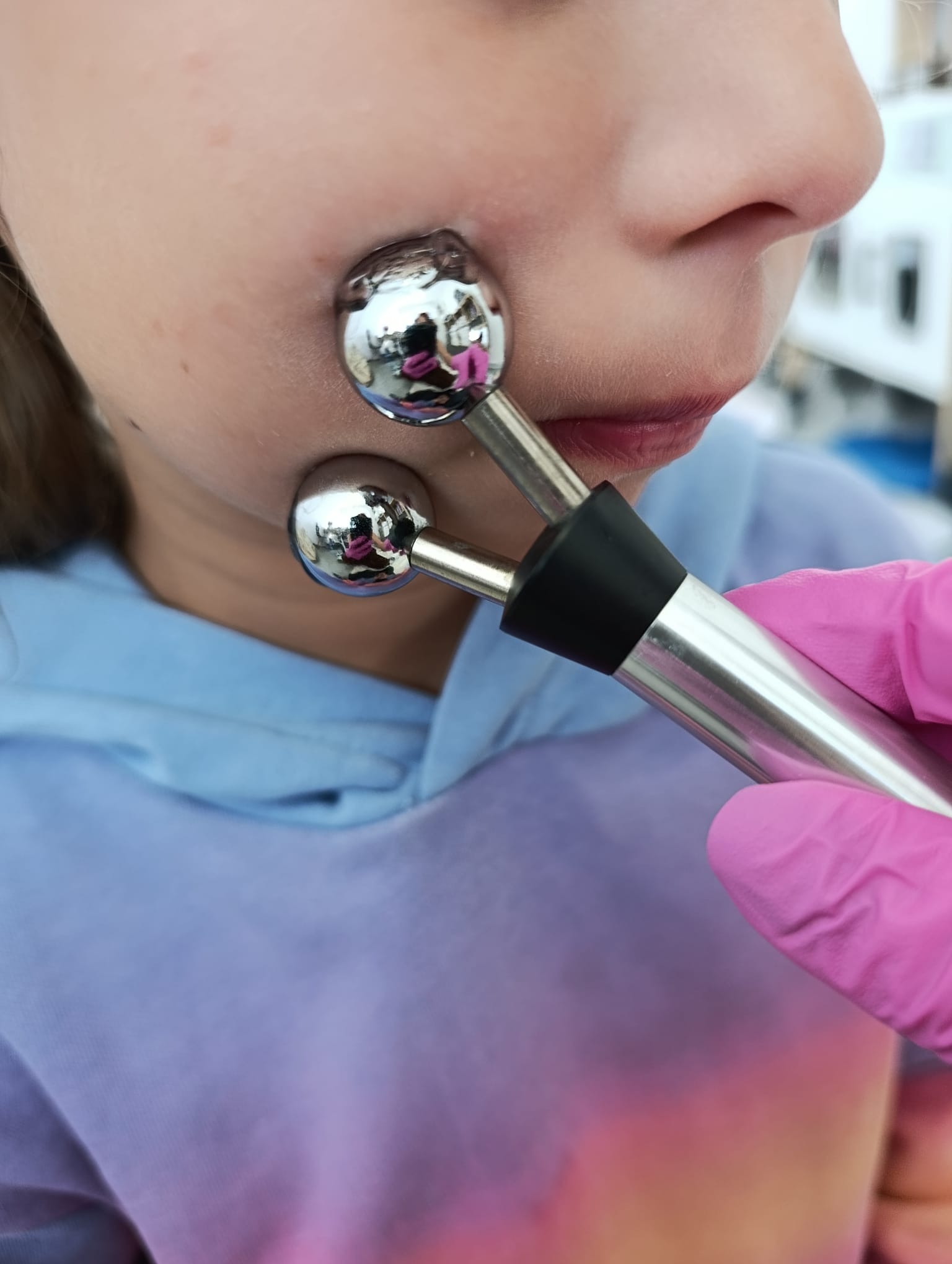 Zabieg z użyciem metalowych elektrod kulkowych na twarzy pacjenta, wykonywany przez osobę w różowych rękawiczkach. Widoczny fragment twarzy i niebieska bluza pacjenta.