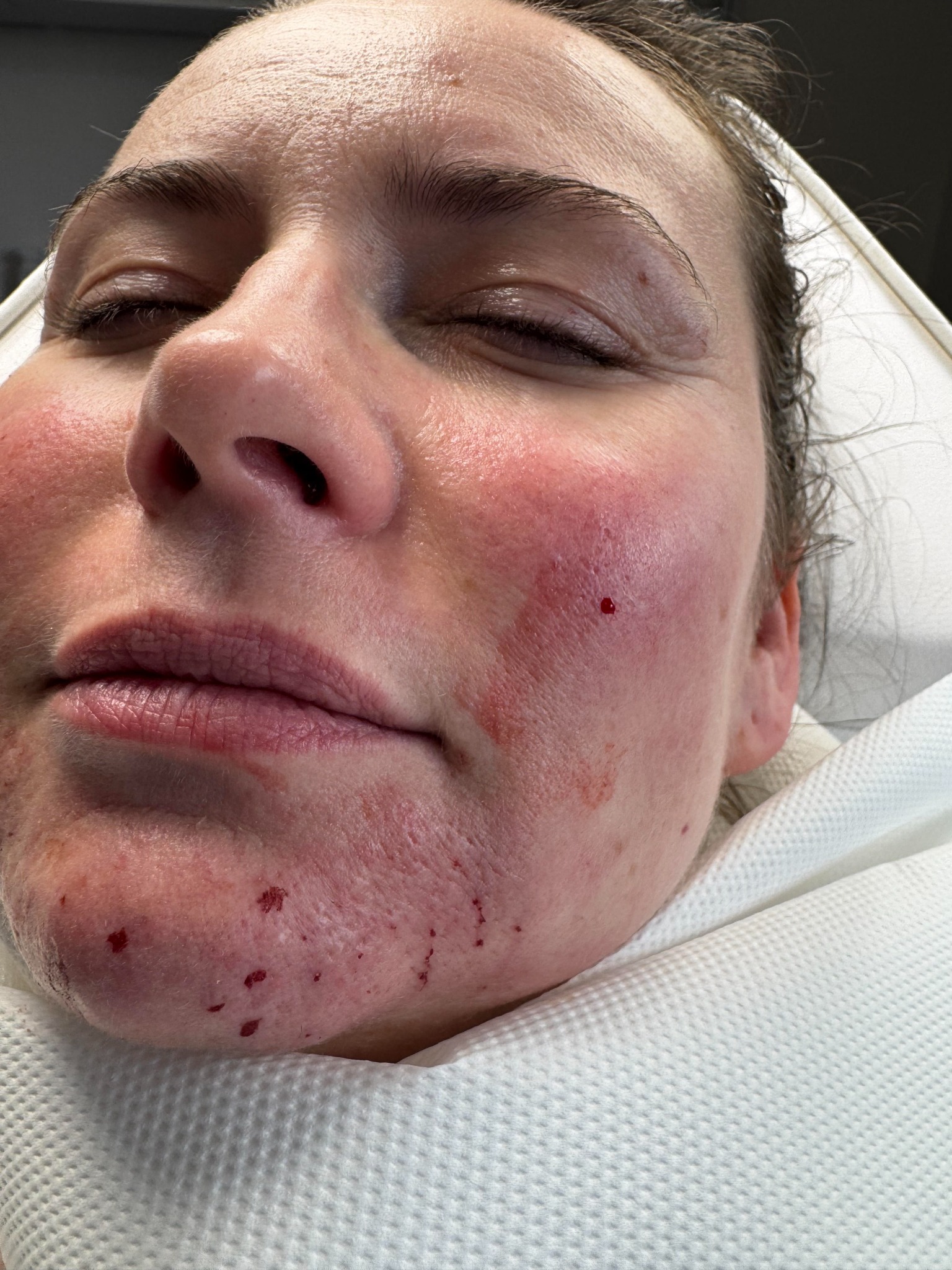 Bliski portret twarzy kobiety po zabiegu kosmetycznym, widoczne zaczerwienienia i drobne ślady krwi na skórze policzków i brody, oczy zamknięte, leży na białym podkładzie.