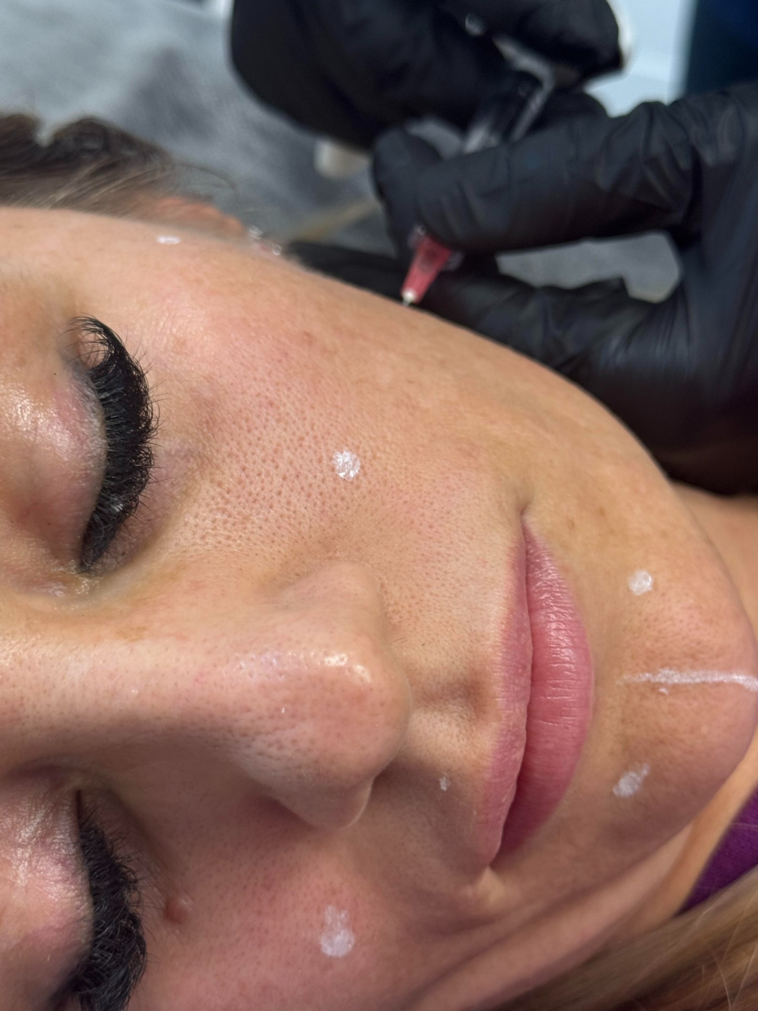 Zabieg medycyny estetycznej: zbliżenie na twarz kobiety z zaznaczonymi punktami iniekcji, w trakcie podawania preparatu cienką igłą przez osobę w czarnych rękawiczkach.