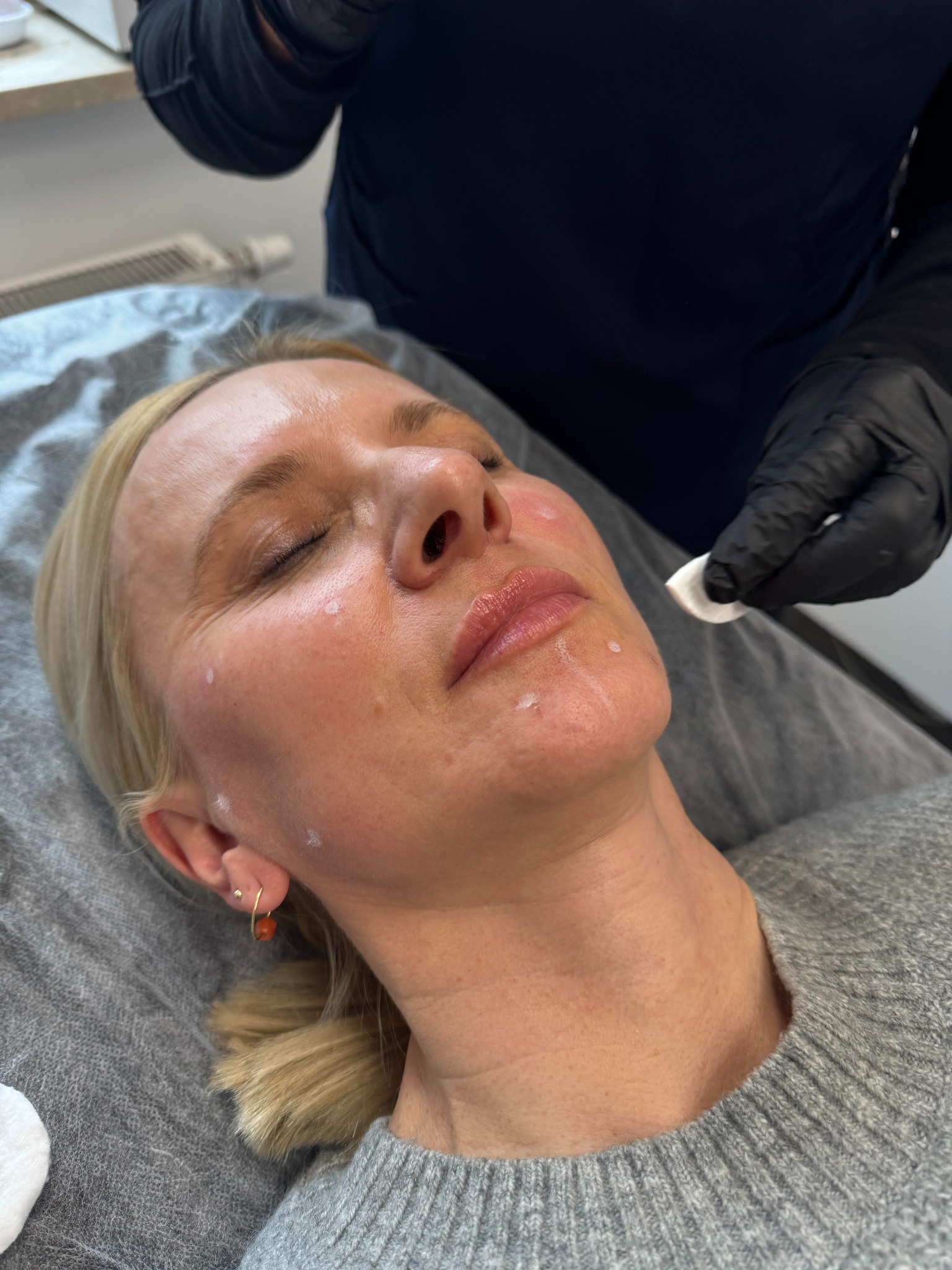 Kobieta z zamkniętymi oczami leżąca na leżance podczas zabiegu z nałożonymi punktowo kremami na twarzy, przygotowywana do procedury przez osobę w czarnych rękawiczkach trzymającą wacik.