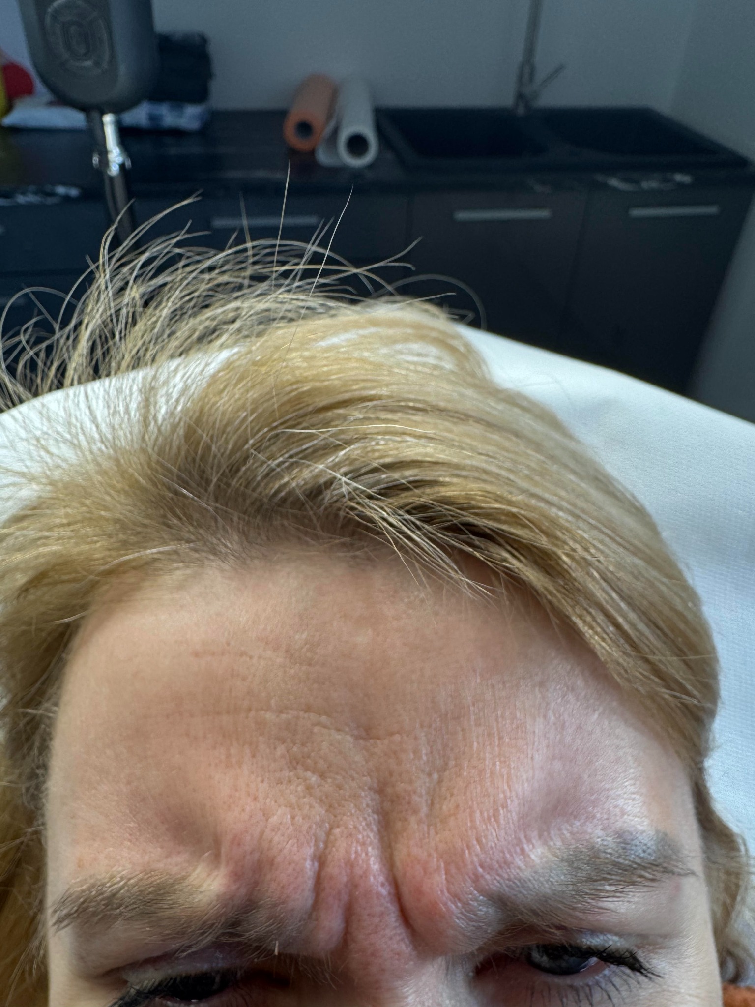 Blond włosy, zmarszczki na czole i widoczne bruzdy na twarzy kobiety, leżącej na białym podłożu w gabinecie lekarskim.