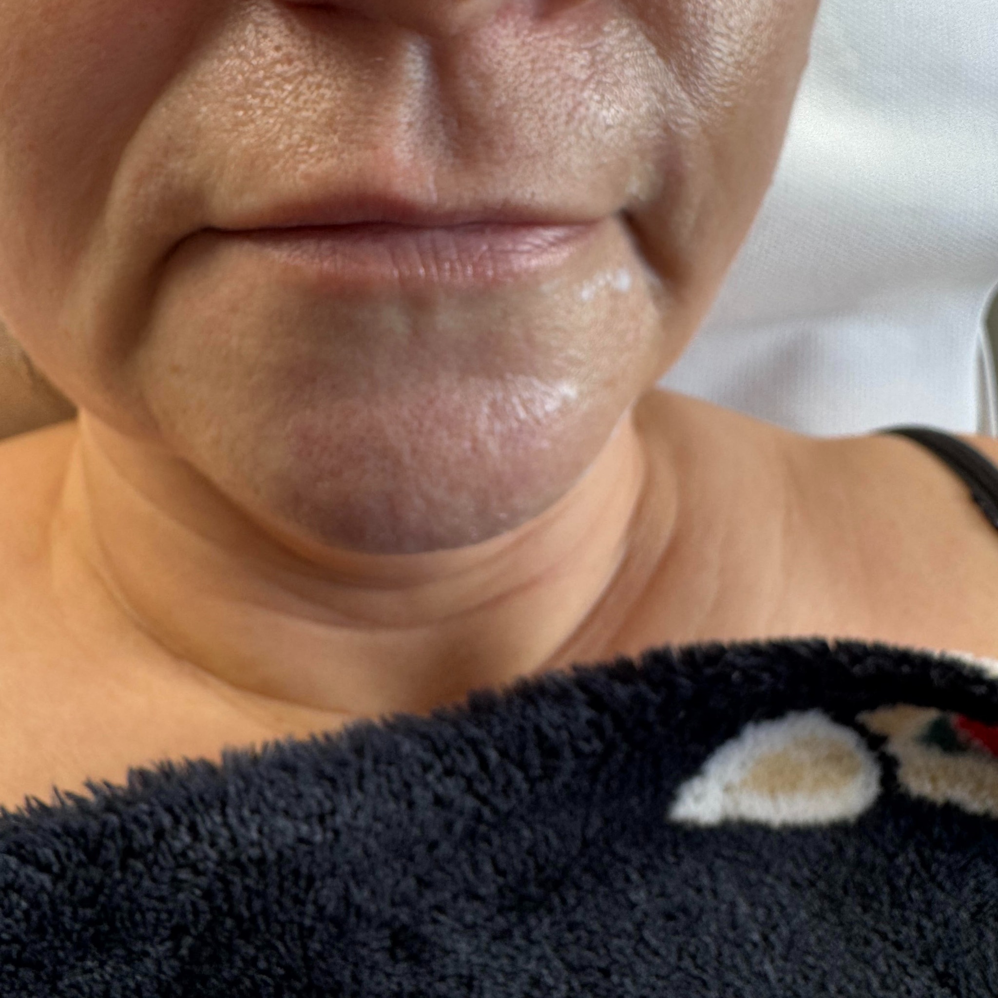 Zbliżenie na dolną część twarzy kobiety przed zabiegiem. Widoczne drobne zmarszczki wokół ust i na brodzie. Skóra z lekkim połyskiem. W tle biała pościel i fragment czarnego koca.