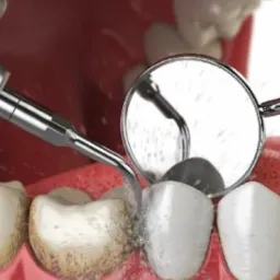 Usuwanie kamienia nazębnego z użyciem skalera ultradźwiękowego i lusterka stomatologicznego, widoczne drobne cząsteczki wody i osadu.