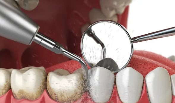 Usuwanie kamienia nazębnego z użyciem skalera ultradźwiękowego i lusterka stomatologicznego, widoczne drobne cząsteczki wody i osadu.