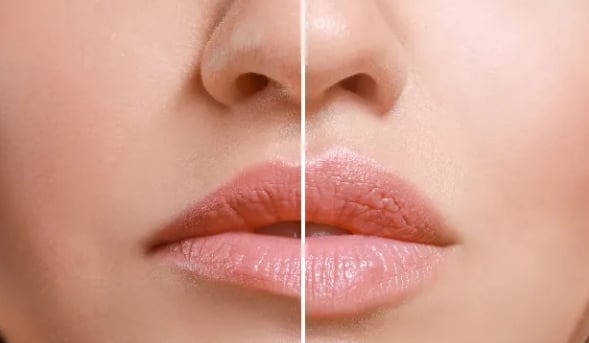 Zbliżenie na kobiece usta przed i po zabiegu, z widoczną różnicą w nawilżeniu i objętości, delikatne oświetlenie.
