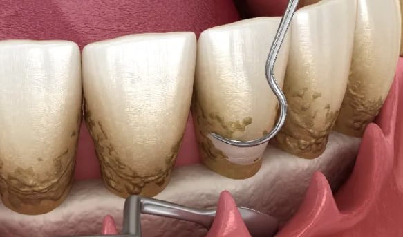 Animacja 3D przedstawiająca proces usuwania kamienia nazębnego przy użyciu narzędzia dentystycznego, widoczne osady na zębach przed zabiegiem.