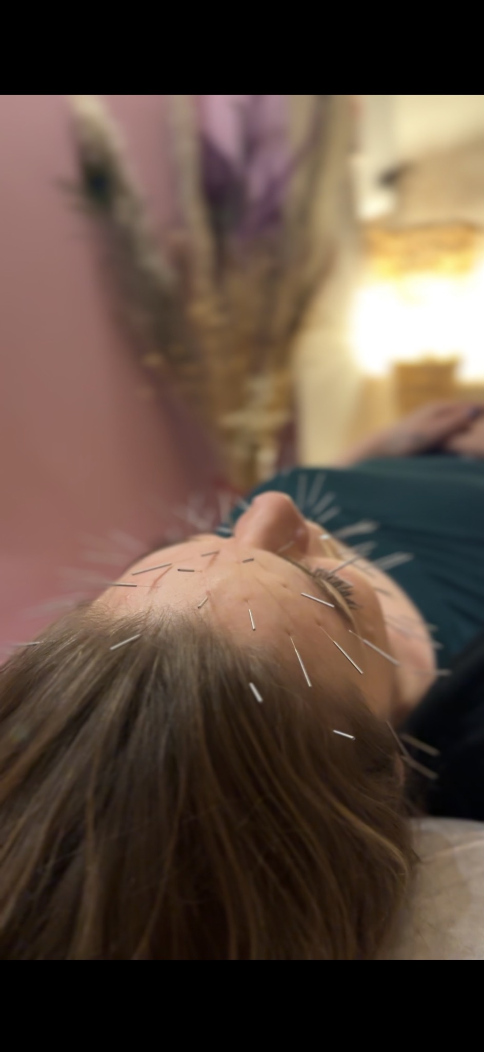 Kobieta leży na plecach z igłami na twarzy, zabieg w gabinecie z rozmytym tłem.