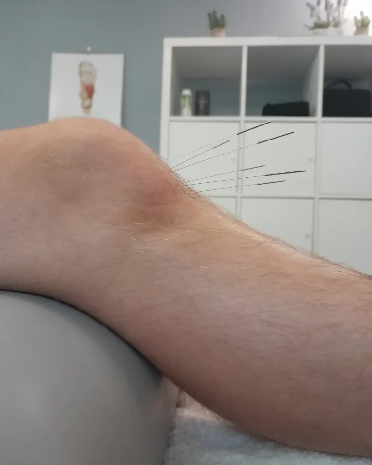 Zabieg akupunktury kolana z bliska. Widoczne cienkie igły wbite w skórę, jasne tło z regałem i grafiką stopy. Ujęcie z boku, na leżance.