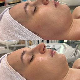 Zabieg oczyszczania skóry to podstawowy, ale niezwykle ważny rytuał pielęgnacyjny, który pozwala przywrócić cerze świeżość, blask i zdrowy wygląd. P