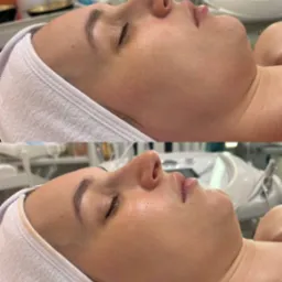 Zdjęcie 'przed i po' zabiegu na twarz. Widoczna twarz kobiety z bliska, leżącej na leżance, z ręcznikiem na głowie. Skóra przed i po zabiegu.