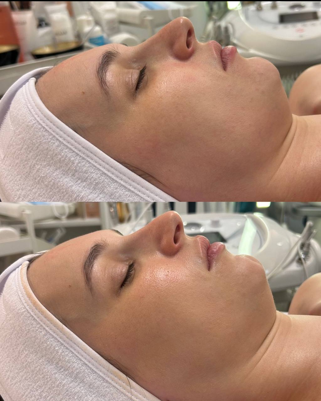 Zdjęcie 'przed i po' zabiegu na twarz. Widoczna twarz kobiety z bliska, leżącej na leżance, z ręcznikiem na głowie. Skóra przed i po zabiegu.