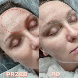 HUMAN BEAUTY Centrum Urody, Salon Kosmetyczny Chrzanów - Oczyszczanie wodorowe, efekt po jednym zabiegu Basic