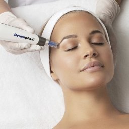 OG Cosmetology - Zabieg Dermapen 4 na twarzy kobiety z zamkniętymi oczami, wykonywany przez osobę w rękawiczkach na białym tle.