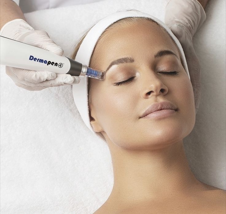 Zabieg Dermapen 4 na twarzy kobiety z zamkniętymi oczami, wykonywany przez osobę w rękawiczkach na białym tle.