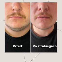 Skóra Balans - Męska twarz przed i po dwóch zabiegach, widoczne zmniejszenie zaczerwienienia skóry i poprawa jej wyglądu. Porównanie 'Przed' i 'Po 2 zabiegach'.