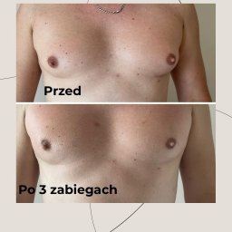Skóra Balans - Męska klatka piersiowa: porównanie 'przed' i 'po' 3 zabiegach, ukazujące redukcję owłosienia i poprawę wyglądu skóry, na beżowym tle z logo firmy.
