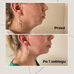Skóra Balans - Zdjęcie 'przed i po' prezentujące efekt zabiegu na szyję. Widoczne zmiany w napięciu skóry i redukcji podbródka. Profil kobiety, kolczyki koła z zawieszkami.