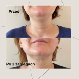 Skóra Balans - Zdjęcie 'przed i po' z widoczną poprawą stanu skóry szyi i dekoltu po dwóch zabiegach. Na górze ujęcie 'przed', na dole 'po'.