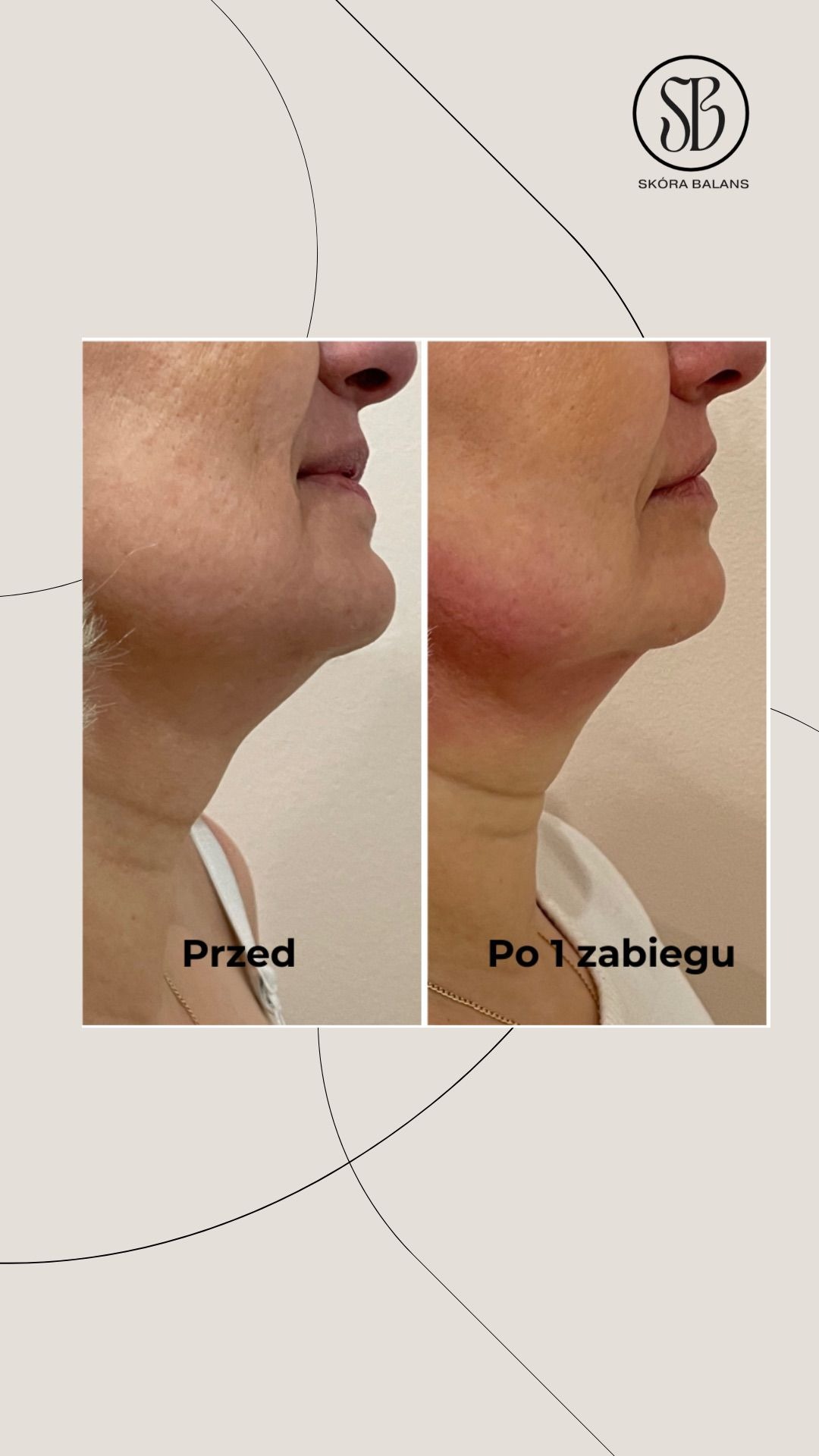 Efekt liftingu szyi: porównanie 'Przed' i 'Po' zabiegu, widoczne napięcie skóry i redukcja zmarszczek. Profil kobiety z widocznym podbródkiem.
