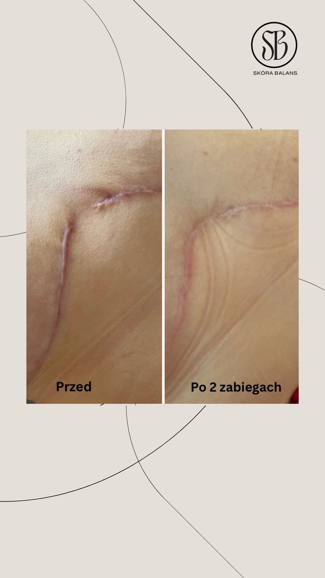 Zdjęcie 'przed i po' zabiegach redukcji blizny na skórze, z widoczną poprawą po dwóch zabiegach. Logo 'SB' w górnym rogu. Blizna częściowo widoczna na obu ujęciach.