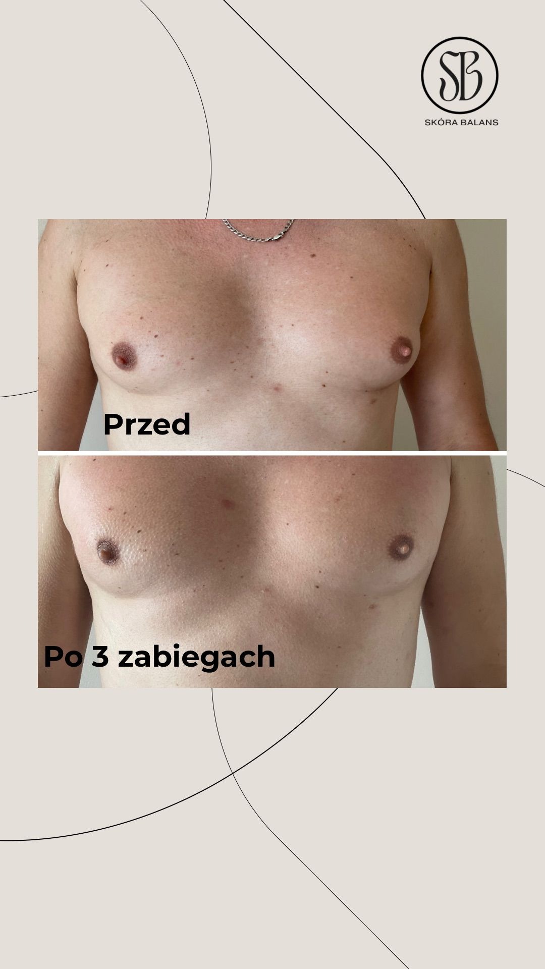 Męska klatka piersiowa: porównanie 'przed' i 'po' 3 zabiegach, ukazujące redukcję owłosienia i poprawę wyglądu skóry, na beżowym tle z logo firmy.