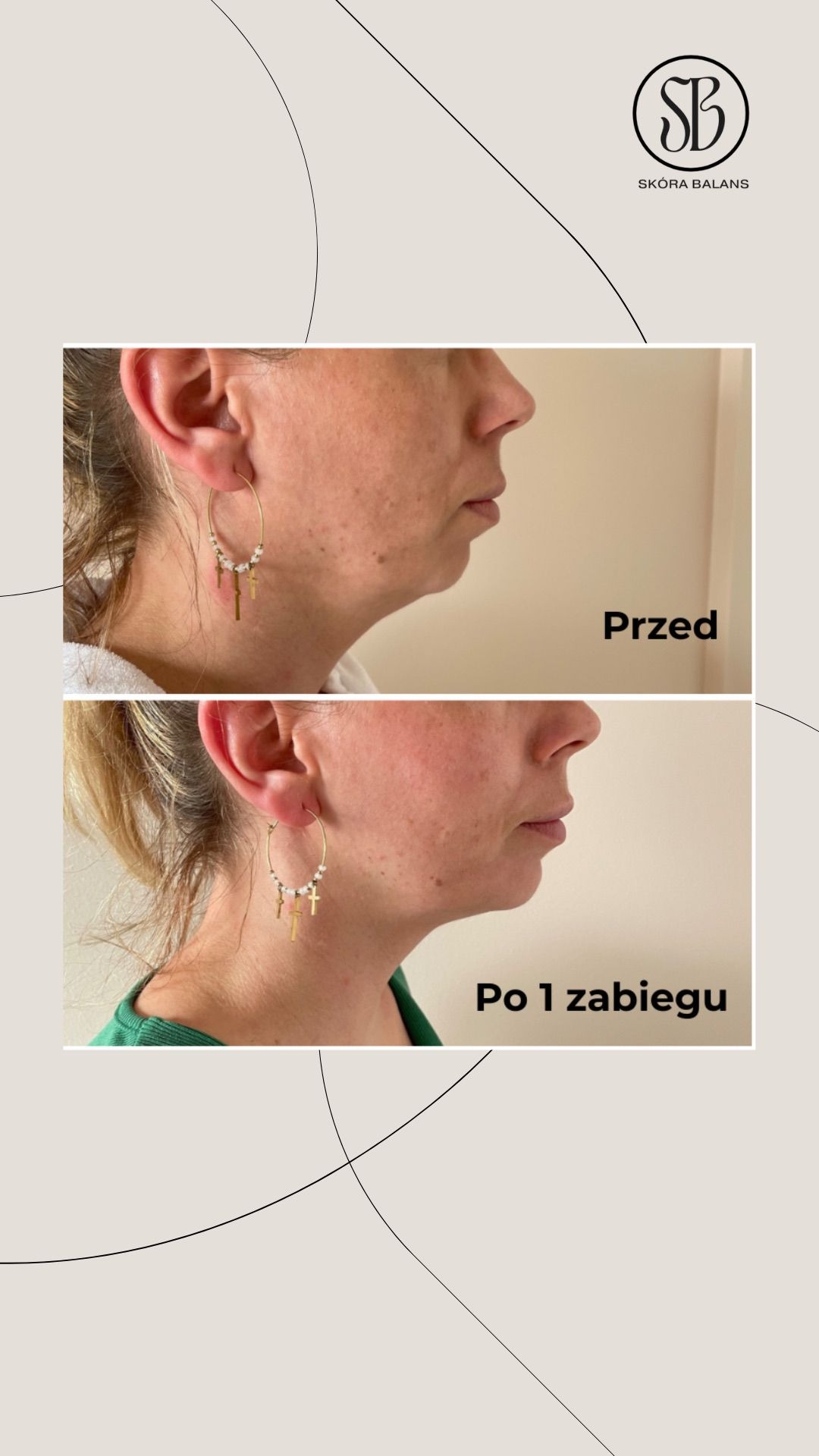 Zdjęcie 'przed i po' prezentujące efekt zabiegu na szyję. Widoczne zmiany w napięciu skóry i redukcji podbródka. Profil kobiety, kolczyki koła z zawieszkami.