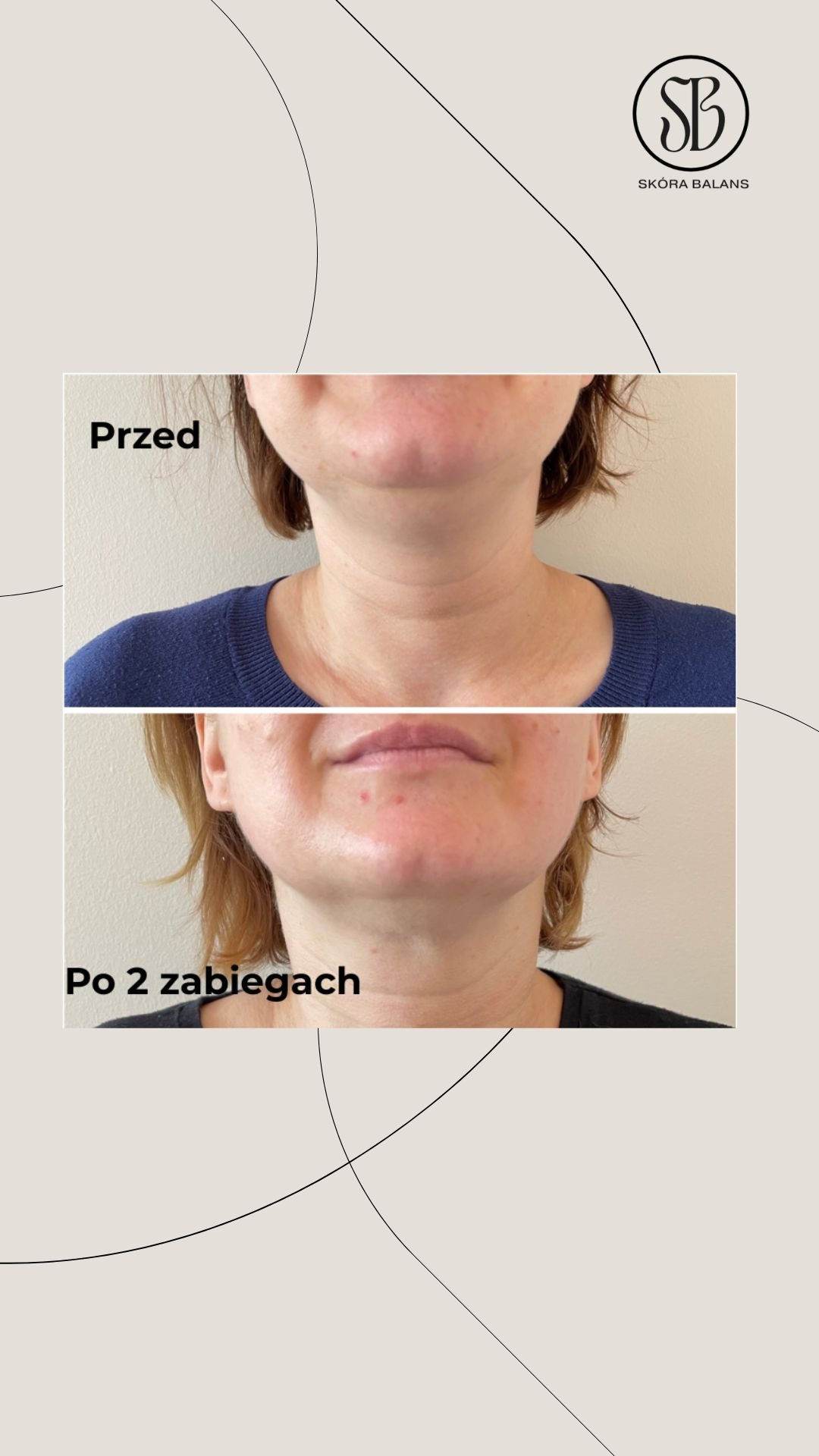 Zdjęcie 'przed i po' z widoczną poprawą stanu skóry szyi i dekoltu po dwóch zabiegach. Na górze ujęcie 'przed', na dole 'po'.