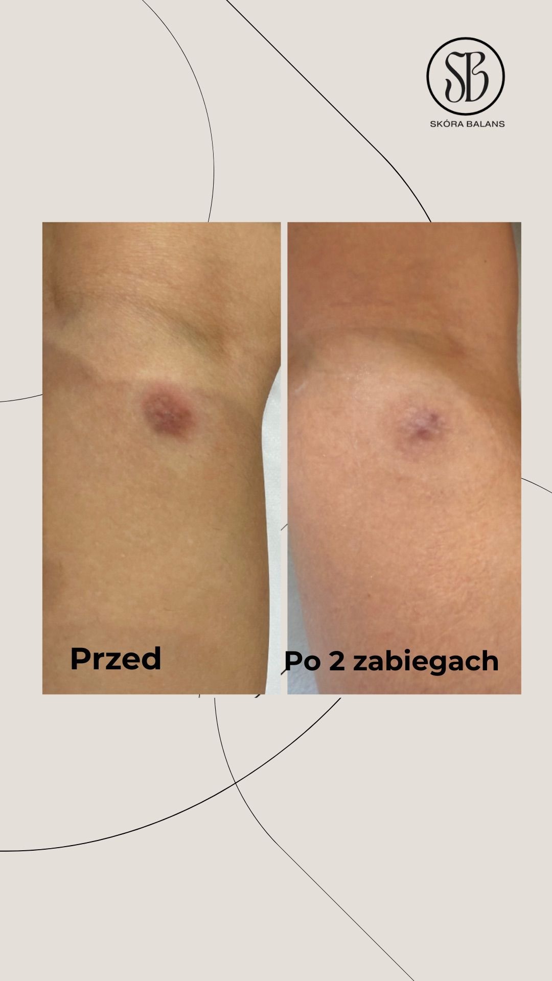 Porównanie skóry 'przed' i 'po' zabiegach. Widoczna redukcja zmiany skórnej po dwóch zabiegach. Ujęcie na beżowym tle z logo firmy.