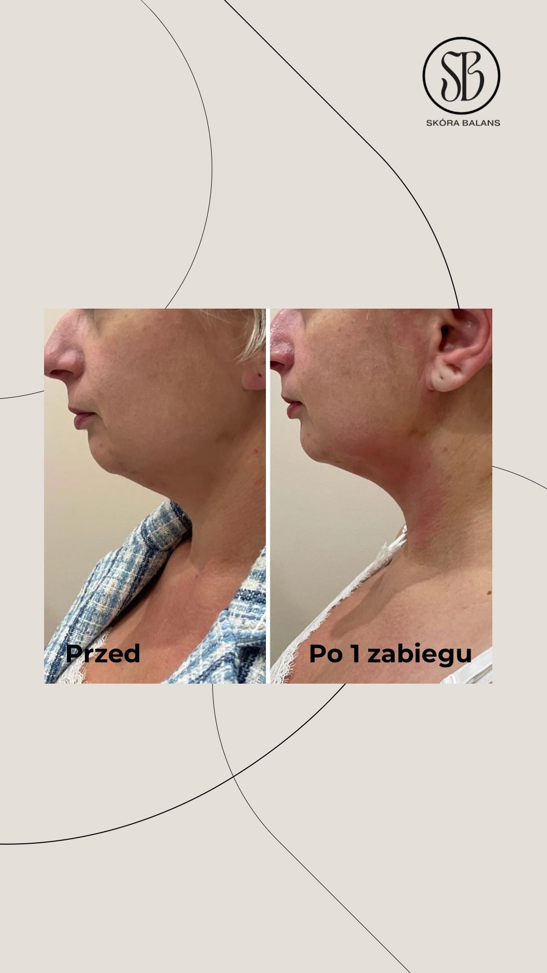 Zdjęcie 'Przed' i 'Po' 1 zabiegu na szyję kobiety, profil, redukcja wiotkości skóry. Logo 'Skóra Balans' w prawym górnym rogu, beżowe tło.