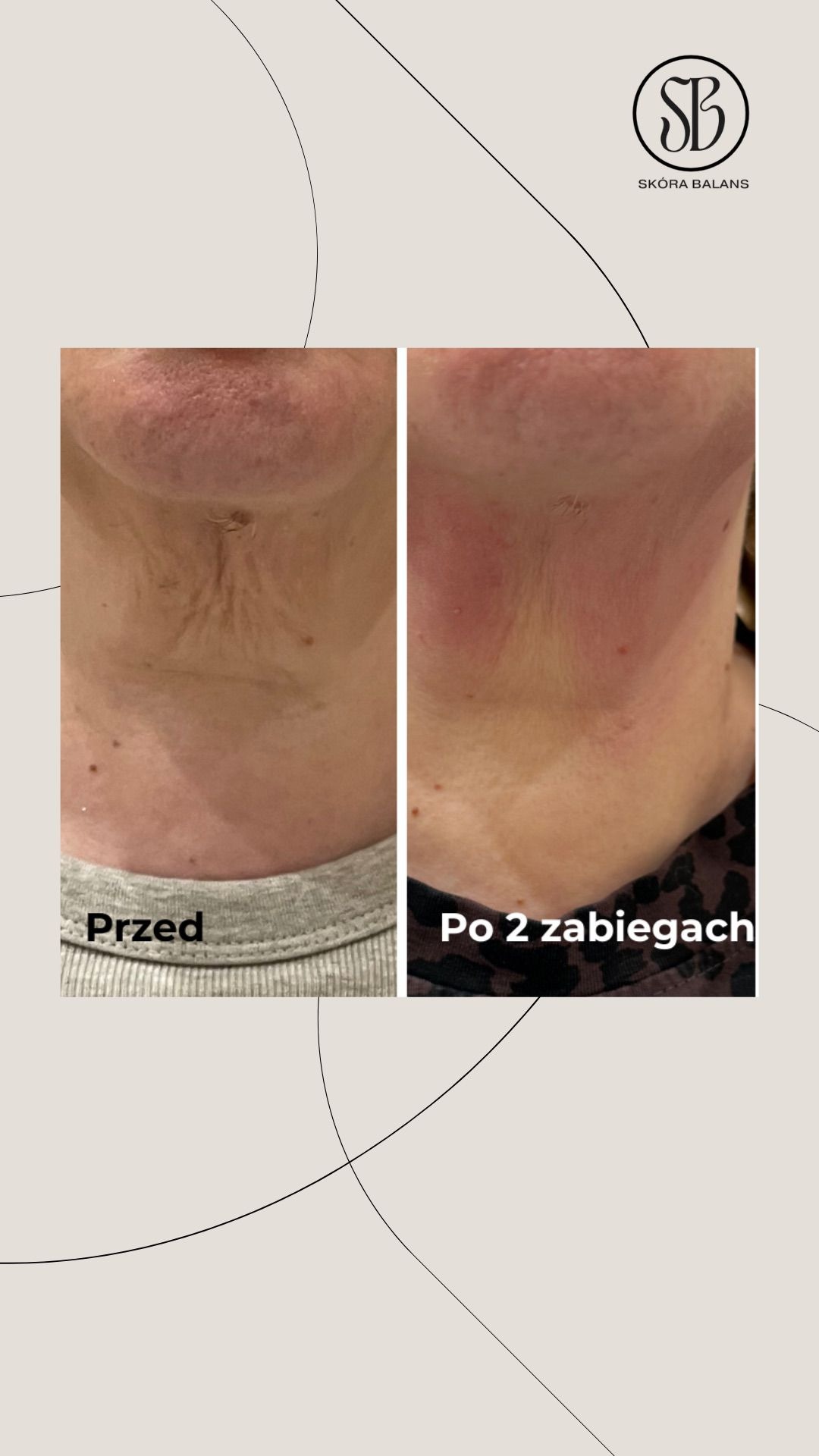 Zdjęcie 'przed i po' z widoczną poprawą skóry szyi po dwóch zabiegach. Lewa strona pokazuje stan przed, prawa po. Widoczne logo 'Skóra Balans'.