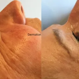 Zdjęcie 'przed i po' zabiegu dermation, ukazujące redukcję zmarszczek wokół oka. Skóra po prawej stronie jest bardziej nawilżona i napięta.