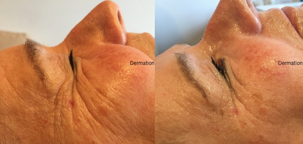 Zdjęcie 'przed i po' zabiegu dermation, ukazujące redukcję zmarszczek wokół oka. Skóra po prawej stronie jest bardziej nawilżona i napięta.