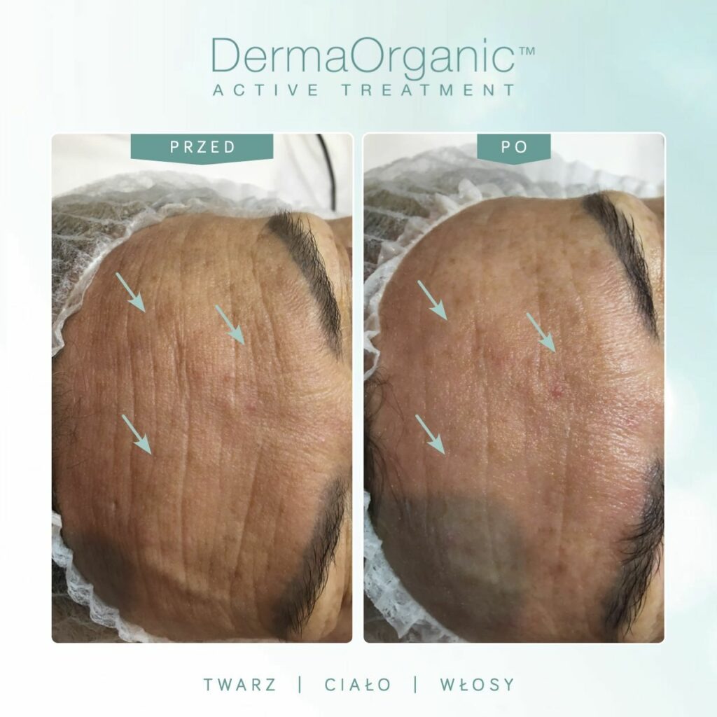 Zdjęcie 'przed i po' zabiegu DermaOrganic na twarz. Widoczne zmniejszenie zmarszczek i poprawa kolorytu skóry. Strzałki wskazują obszary zmian.