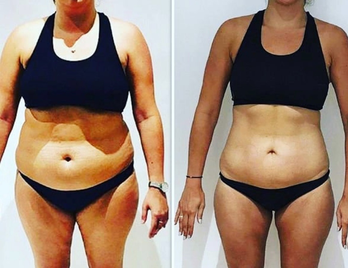 Kobieta w bieliźnie sportowej, prezentująca efekt 'przed i po' redukcji wagi. Widoczna różnica w obwodzie talii i sylwetce. Zmiana w wyglądzie skóry.