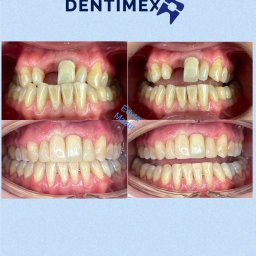 GABINET STOMATOLOGICZNY ''DENTIMEX'' Edyta Mazur - Efekt leczenia protetycznego przed i po w Krakowie: widoczne uzupełnienie brakującego zęba, poprawa estetyki uśmiechu i wyrównanie linii dziąseł.