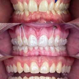 GABINET STOMATOLOGICZNY ''DENTIMEX'' Edyta Mazur - Trzy ujęcia zębów: przed, w trakcie leczenia ortodontycznego z przezroczystymi nakładkami i po leczeniu, prezentujące efekt prostowania zębów.