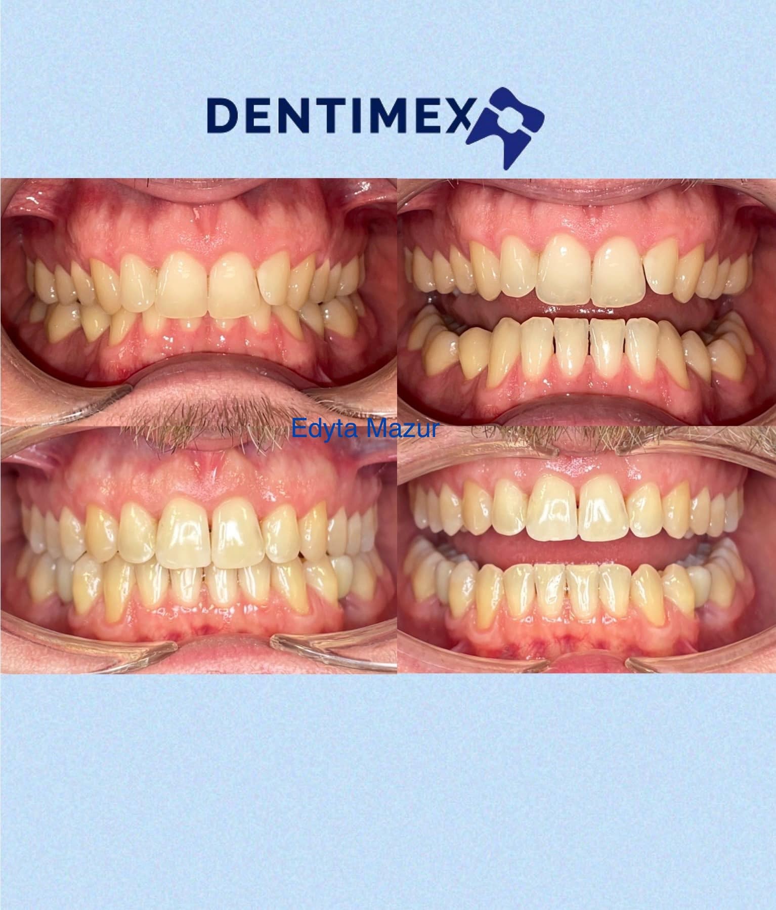 Cztery zdjęcia zębów pacjenta przed i po leczeniu ortodontycznym, z logo Dentimex i podpisem Edyta Mazur na jasnoniebieskim tle.