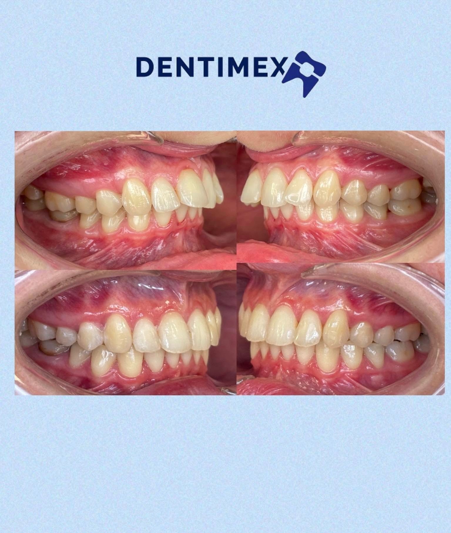 Cztery ujęcia uzębienia pacjenta DENTIMEX z różnych perspektyw, prezentujące szczegóły zgryzu i stanu zębów na jednolitym, jasnoniebieskim tle.