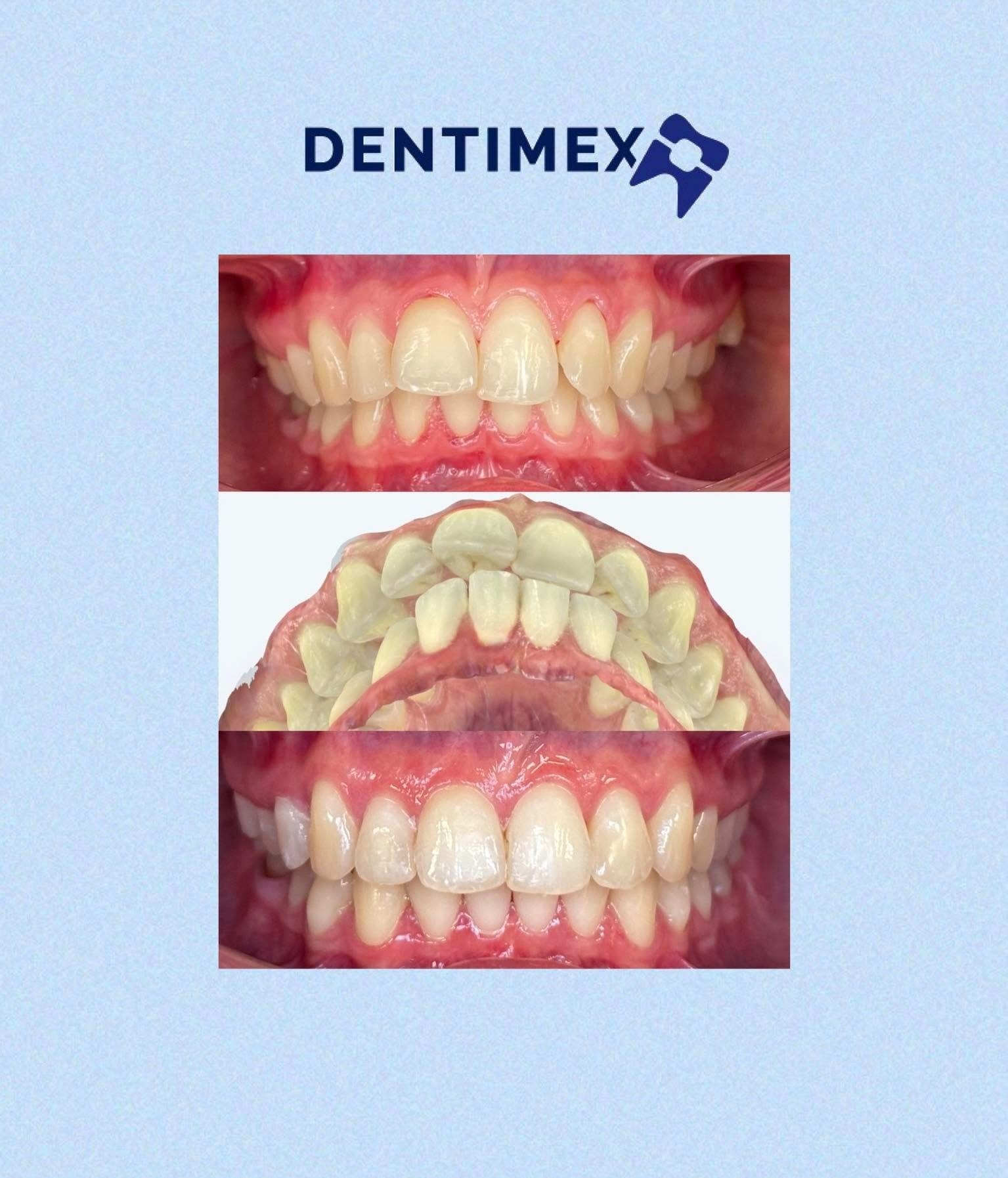 Zdjęcie przedstawia zęby przed i po leczeniu ortodontycznym, z widocznym aparatem ortodontycznym na środkowym ujęciu. Ujęcie z bliska, z logo firmy DENTIMEX u góry.