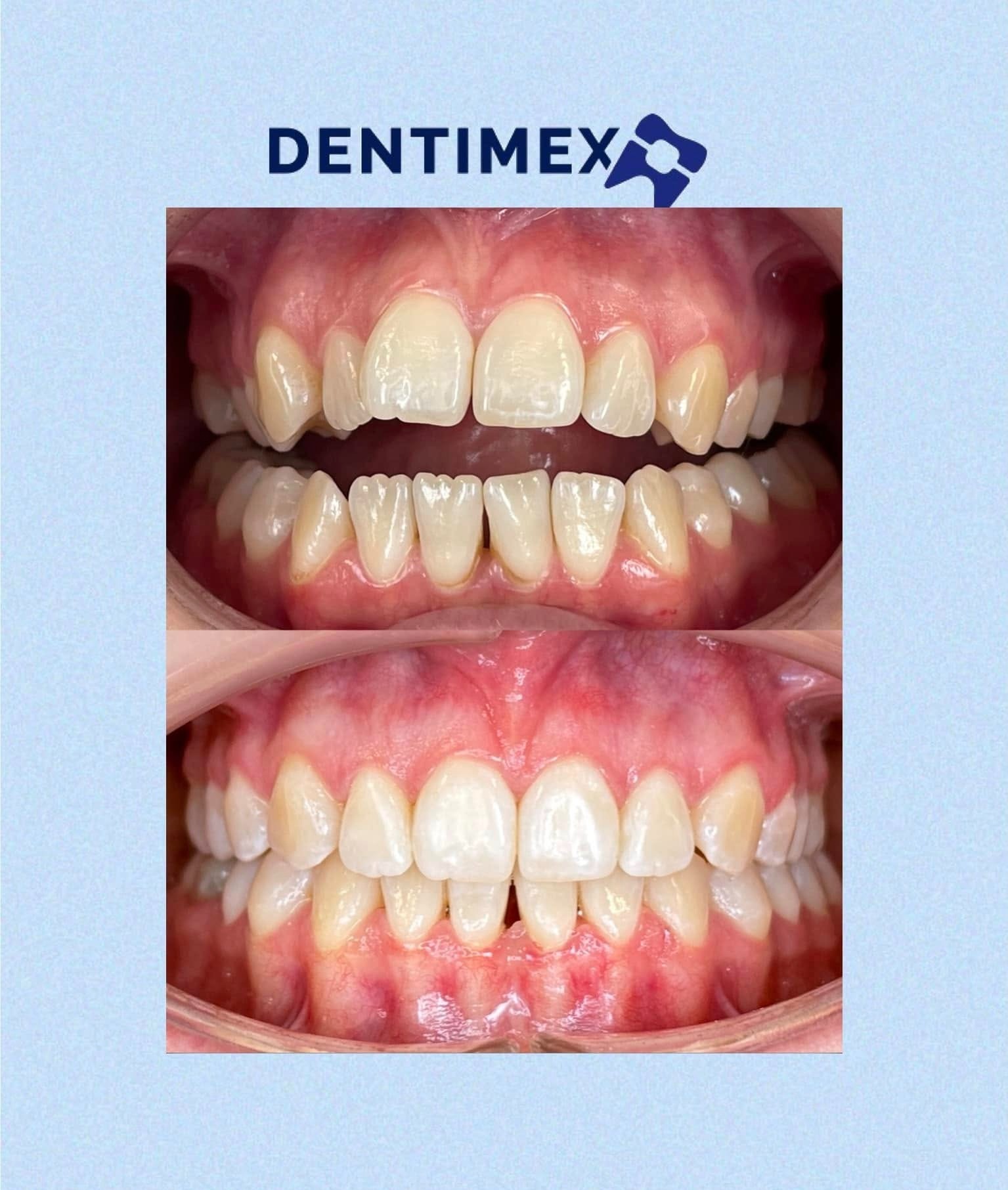 Zbliżenie na górny i dolny łuk zębowy pacjenta, prezentujące zęby przed i po zabiegu, z logo DENTIMEX w górnej części kadru.