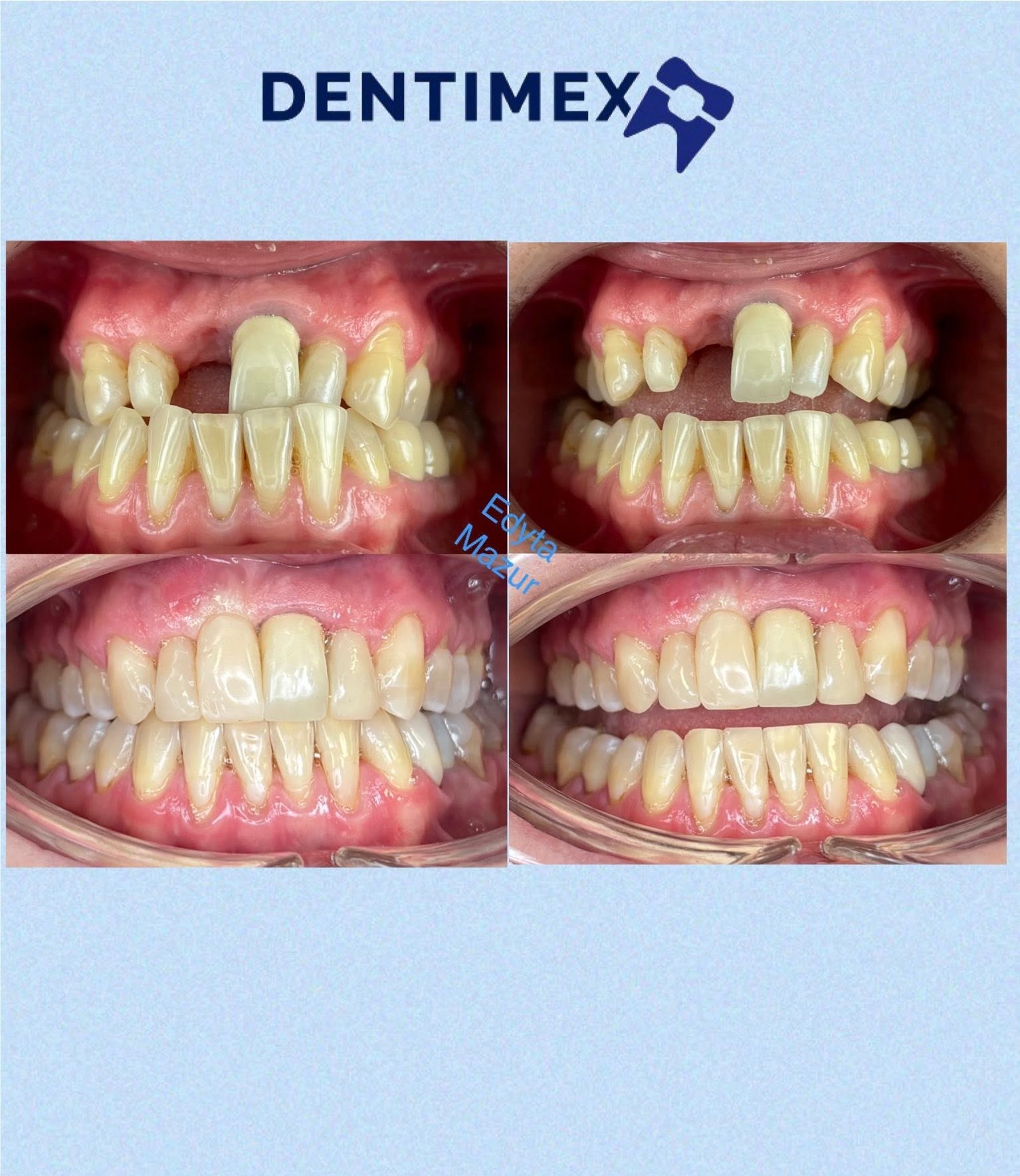 Efekt leczenia protetycznego przed i po w Krakowie: widoczne uzupełnienie brakującego zęba, poprawa estetyki uśmiechu i wyrównanie linii dziąseł.