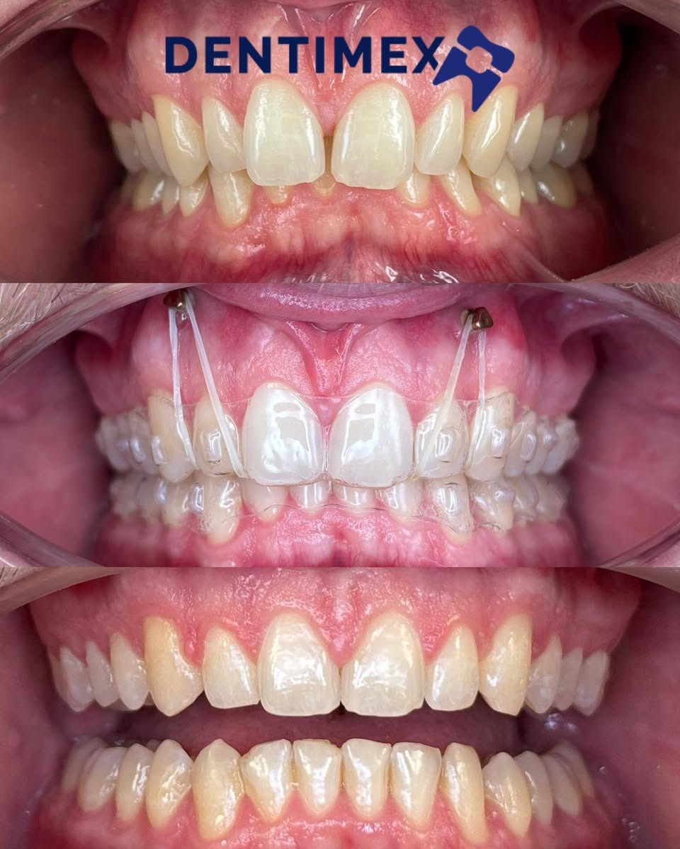 Trzy ujęcia zębów: przed, w trakcie leczenia ortodontycznego z przezroczystymi nakładkami i po leczeniu, prezentujące efekt prostowania zębów.