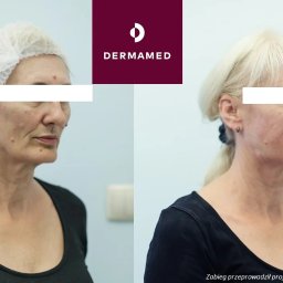 Dermamed - Efekt zabiegu z użyciem stymultorów tkankowych