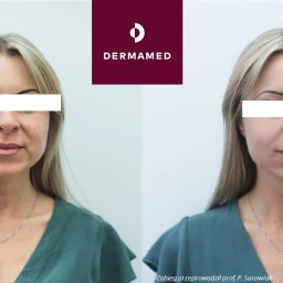 Dermamed - Efekt zabiegu z użyciem stymulatorów tkankowych
