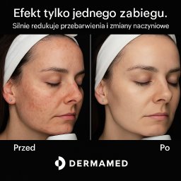 Efekt laserowego fotoodmładzania światłem szerokopasmowym. 